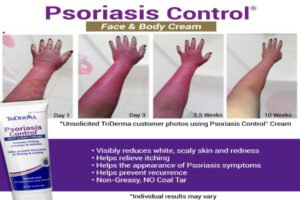 Psoriasis Control Cream - 4.2 oz - 4-Pack Value Bundle - Image 3